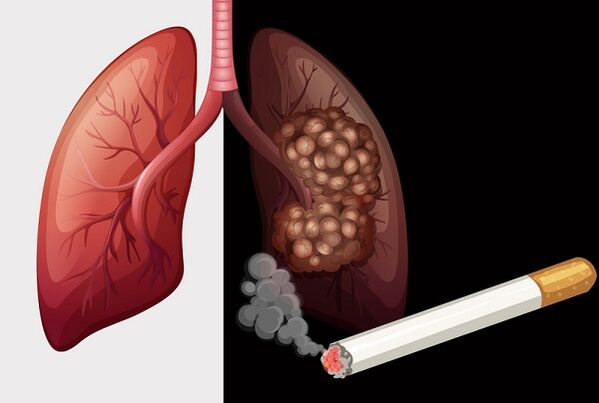 kadilska pljuča in zdrava pljuča